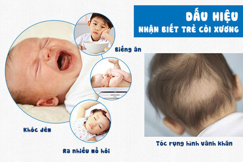 Dấu hiệu còi xương ở trẻ