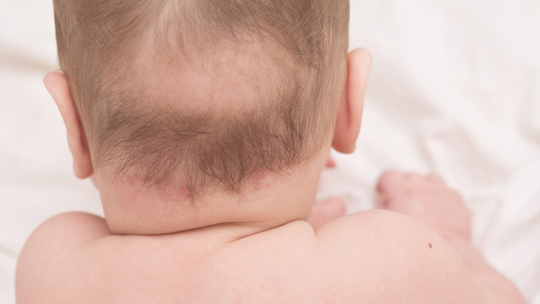 4 kiểu rụng tóc ở trẻ sơ sinh khiến ba mẹ lo lắng
